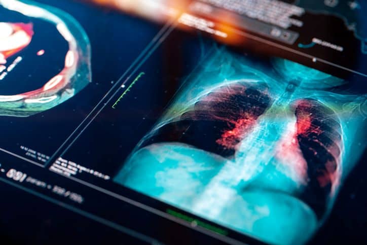 Imaging scan of lungs